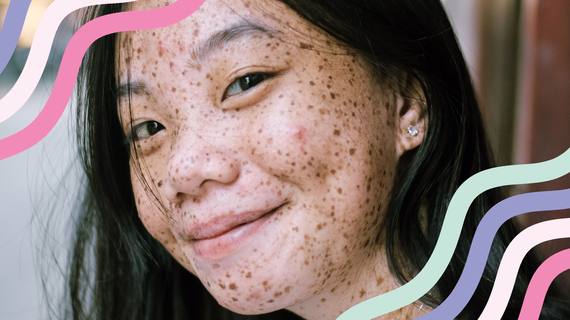 Natural Skincare for Acne-Prone Skin: 8 Tips for Clear and Healthy Skin